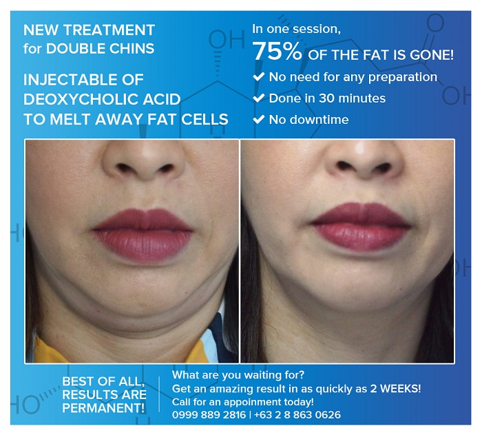 New Treatment for Double Chins