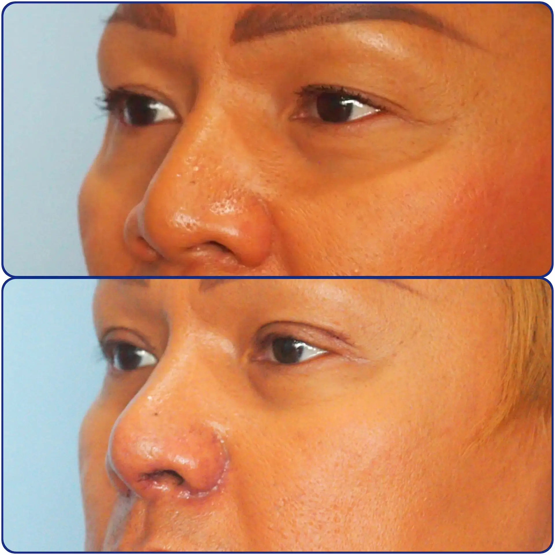 nose surgery before and after